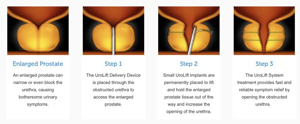 Step by step explanation of the Urolift system